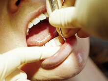 Dental Infections