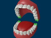 Wsidom teeth growth